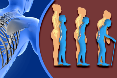 Остеопороз у фокусі жіночого здоров'я